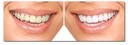 GLORYSMILE Отбеливание зубов гелевые полоски 28 шт.