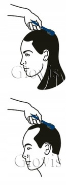 Glovis Roller 0,25 Выпадение волос Облысение Утолщение